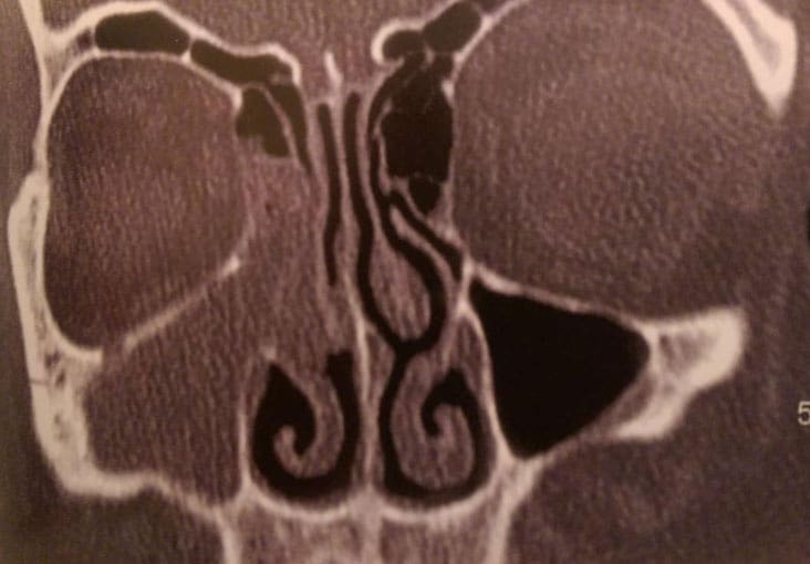 Dr Fawzy - Chronic Sinusitis Image 1