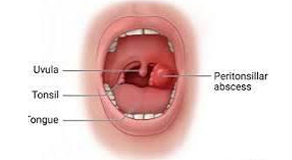 Dr Fawzy - Deep Neck Infections Image 1
