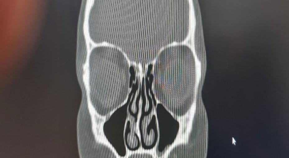 Dr Fawzy - Deviated Septum Image 2
