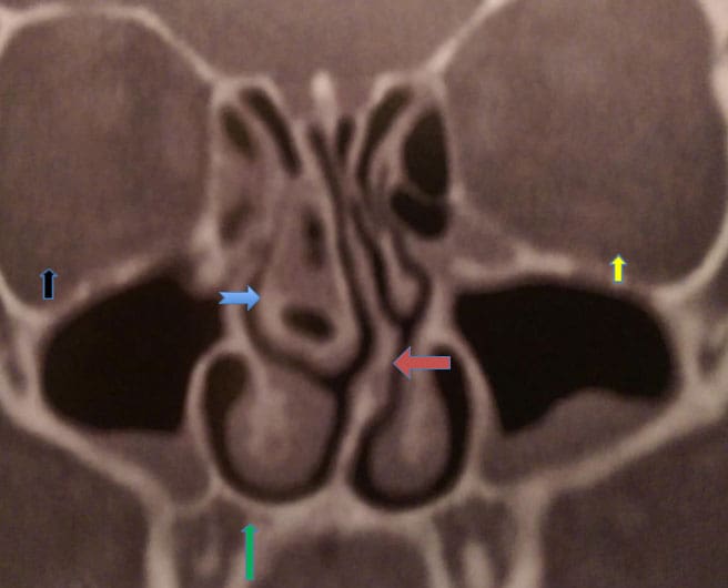 Dr Fawzy - Inferior Turbinates Hypertrophy Image 1