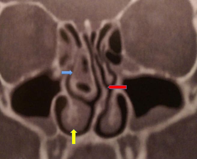 Dr Fawzy - Nasal Obstruction Image 1