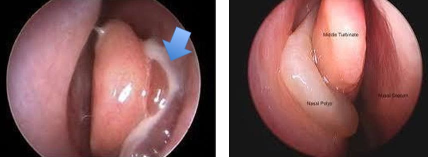 Dr Fawzy - Nasal Polyps Image 1