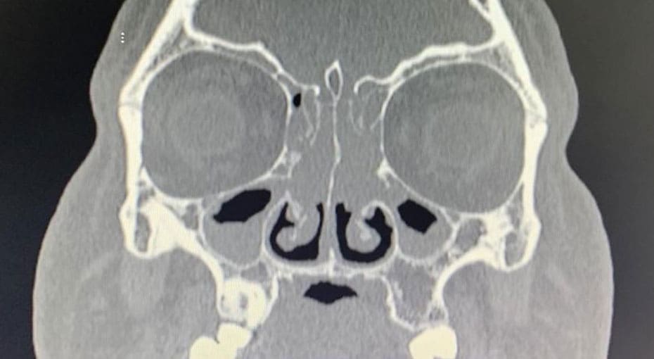 Dr Fawzy - Nasal Polyps Image 2