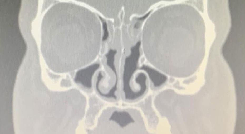 Dr Fawzy - Nasal Polyps Image 3