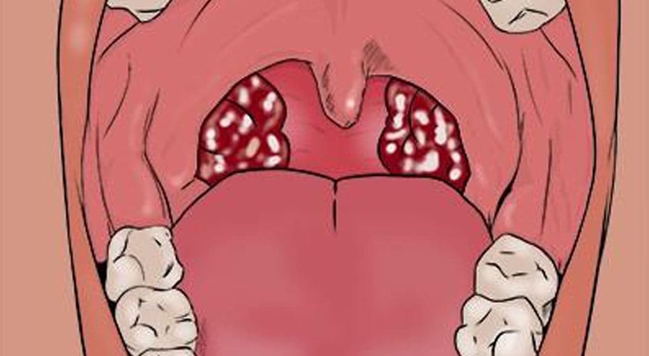 Dr Fawzy - Tonsillitis Image 2