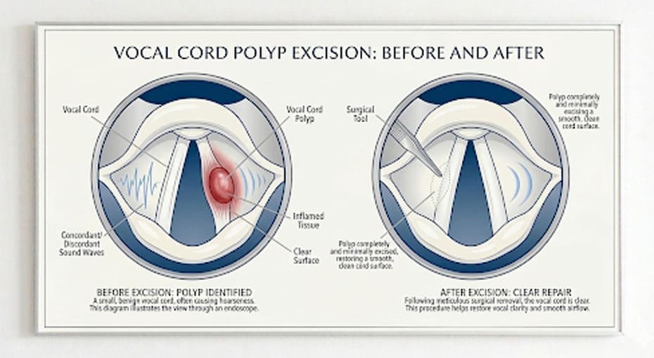 Dr Fawzy - Vocal Cord Polyps Image 1
