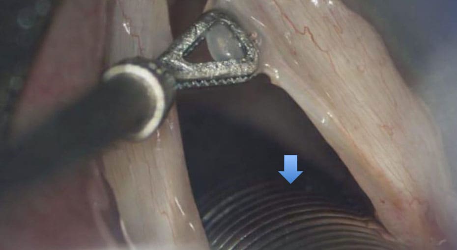 Dr Fawzy - Vocal Cord Polyps Image 2