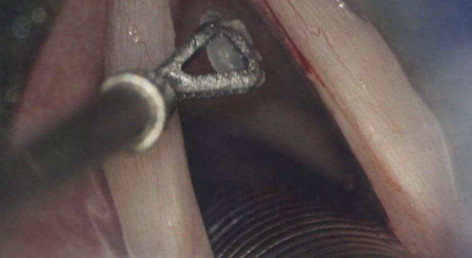 Dr Fawzy - Vocal Cord Polyps Image 3