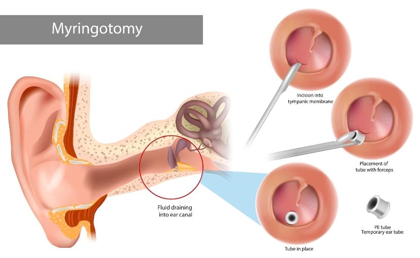 Grommet Insertation Content Dr T