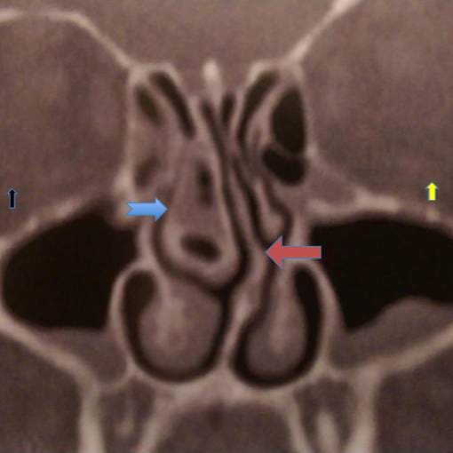 Nasal Obstruction Dr T