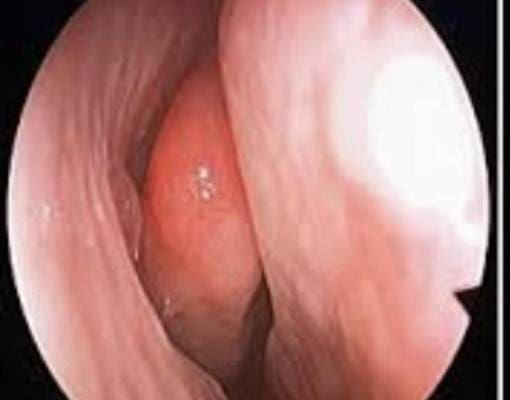 Nasal Polyp Removal After Dr T