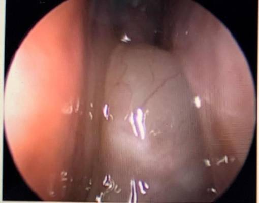 Nasal Polyp Removal Before Dr T