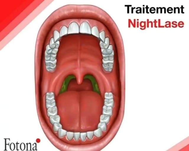 Nightlase Content Image Dr T